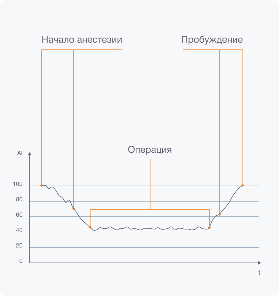 Мониторинг глубины анестезии